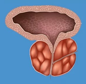 Characteristics of prostatitis
