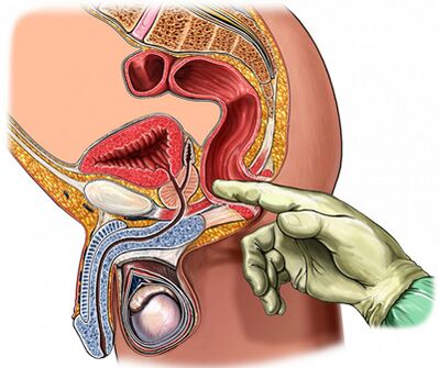 Prostate examination of the finger