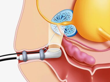 Prostate puncture biopsy