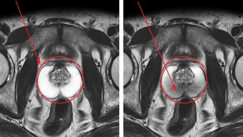 a healthy, inflamed prostate with chronic prostatitis