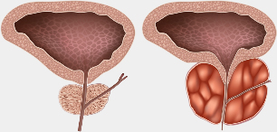 healthy and diseased breast